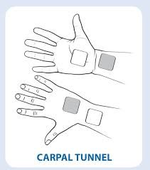 TENs Electrode Placement for Carpal Tunnel