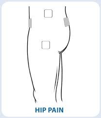 TENs Electrode Placement for Hip Pain