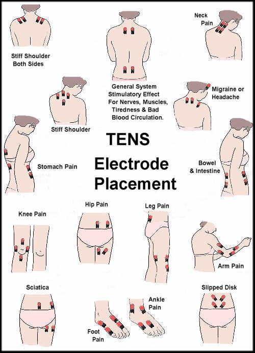 TENs Unit Placement Guide Full Body