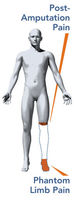 Electrical Stimulation Therapy for Phantom Limb Pain