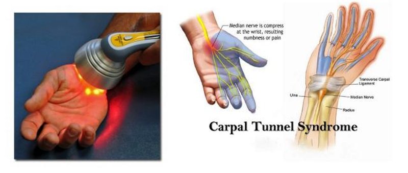 Carpal Tunnel and Non Invasive Low Level Laser Therapy Treatment