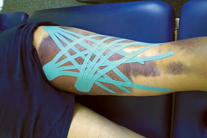 Microcirculatory Kinesio Taping