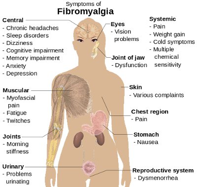 Physical Therapy for Fibromyalgia