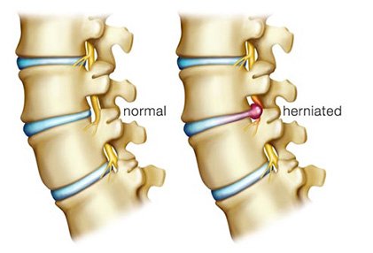 Is a Heating Pad Good for a Herniated Disc?