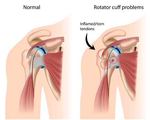Rotator Cuff Physical Therapy