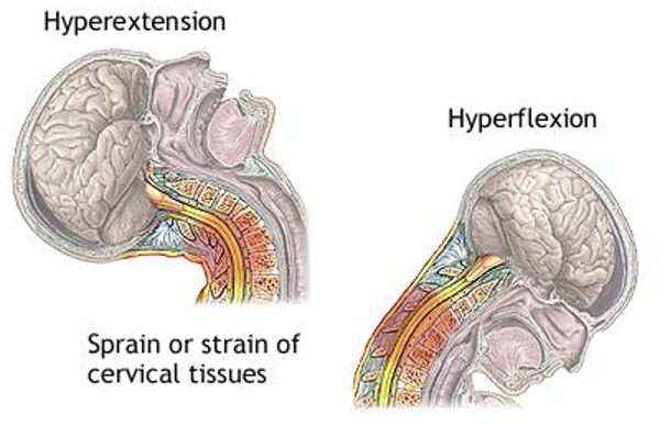 Physical Therapy Treatments for Whiplash