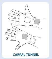 Electrode Placement for Electric Stimulation Charts