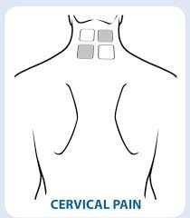 TENs Electrode Placement for Cervical Pain