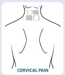 Electrode Placement for Electric Stimulation Charts