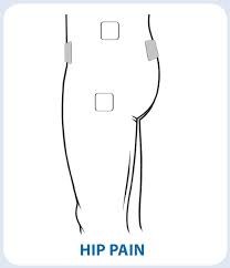 Electrode placement in TENS (a) and HF (b) treatment