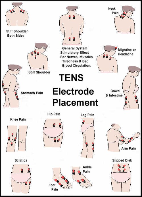 Tens Unit Placement Chart For Plantar Fasciitis