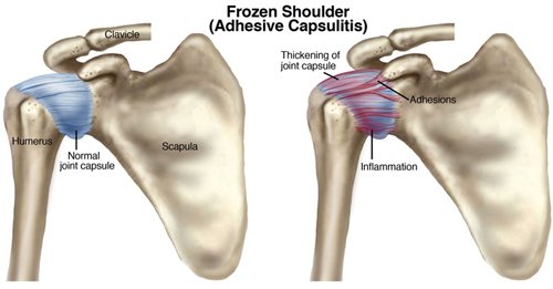 What is Frozen Shoulder